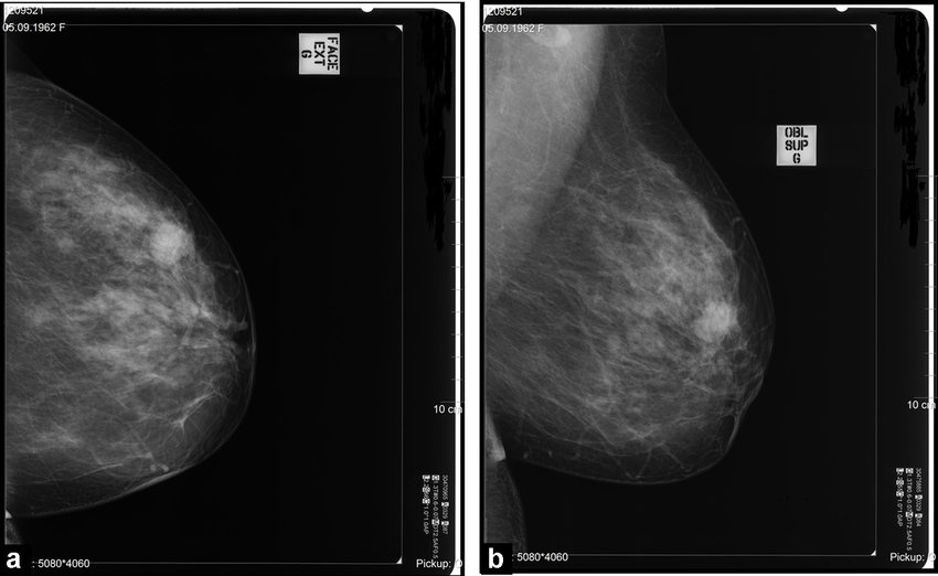 ¿Qué puedes hacer para salvar tu mamografía de la destrucción por las redes sociales?