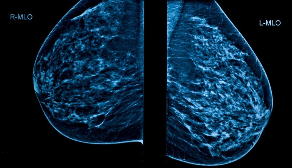Mamografía: ¿Qué es y qué esperar?